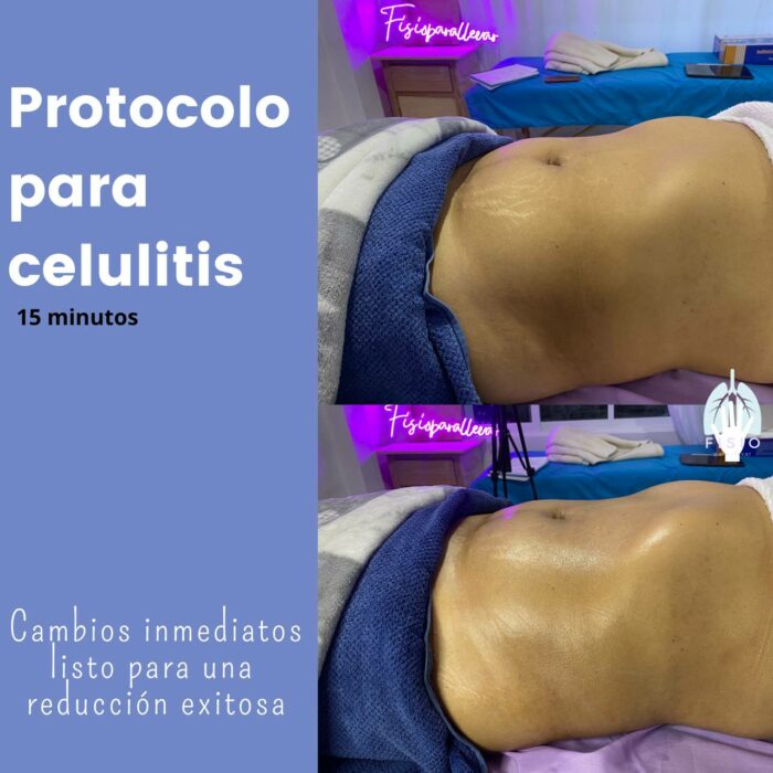 Cupping y Taping Brasileño es bueno